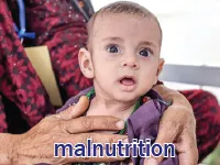 Định nghĩa & cách phát âm từ malnutrition