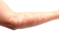 Định nghĩa & cách phát âm từ rash