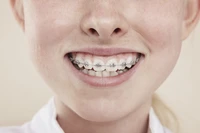 Định nghĩa & cách phát âm từ brace